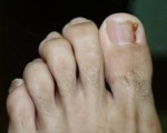 Infekterat nageltrång  